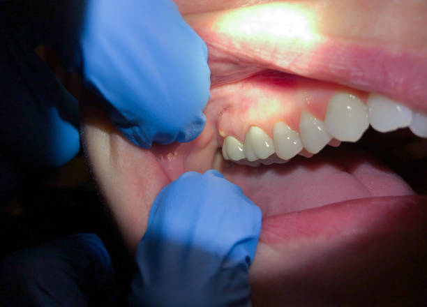Best Emergency Tooth Extraction in Rochester Institute Of Technology, NY